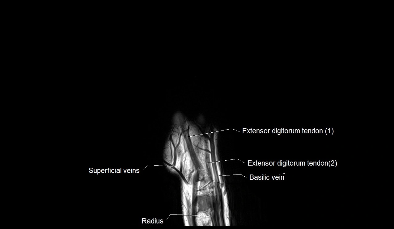 MRI 3T coronal hand cross sectional anatomy image 16.webp